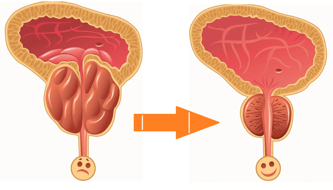 Efecto de Uromexil Forte sobre la próstata con prostatitis y adenoma. 