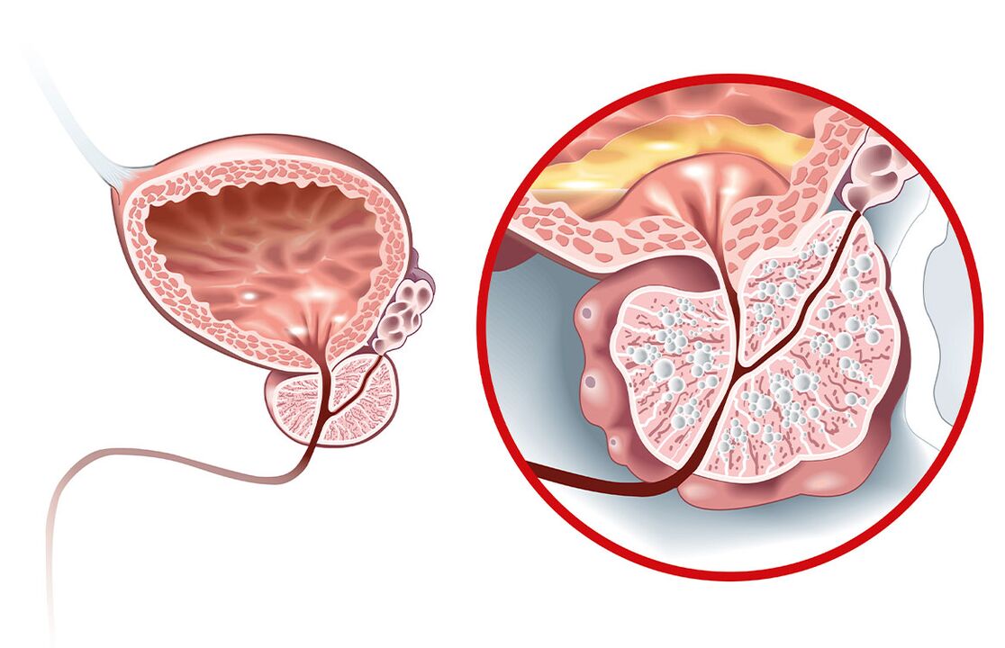 ¿Qué le pasa a la próstata con adenoma y prostatitis 